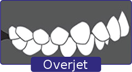 overjet-1